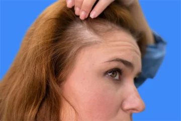 Boutons cuir chevelu