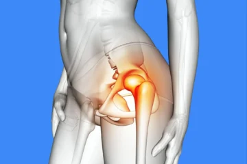 Tendinopathie des fessiers