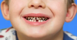 Carie sur dents de lait chez l'enfant