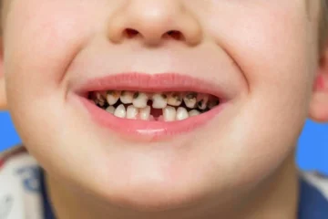 Carie sur dents de lait chez l'enfant