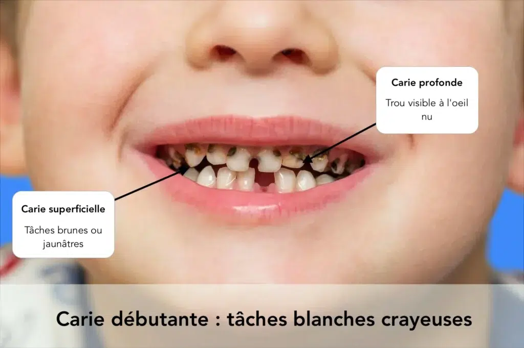 Exemple de carie aux dents de lait