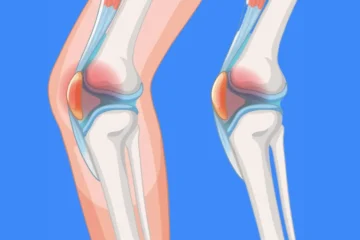 oedeme osseux sous chondral