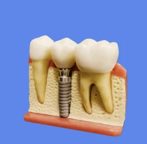 Douleur implant dentaire 10 ans après