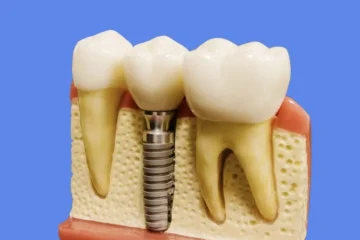 Douleur implant dentaire 10 ans après