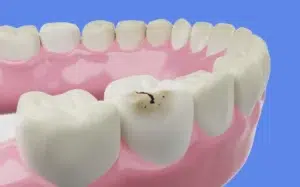 carie dent de sagesse