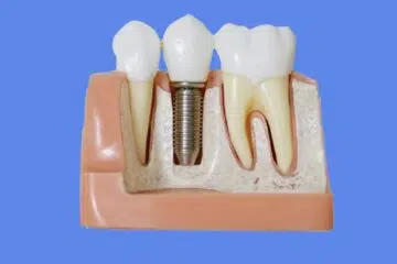 infection implant dentaire