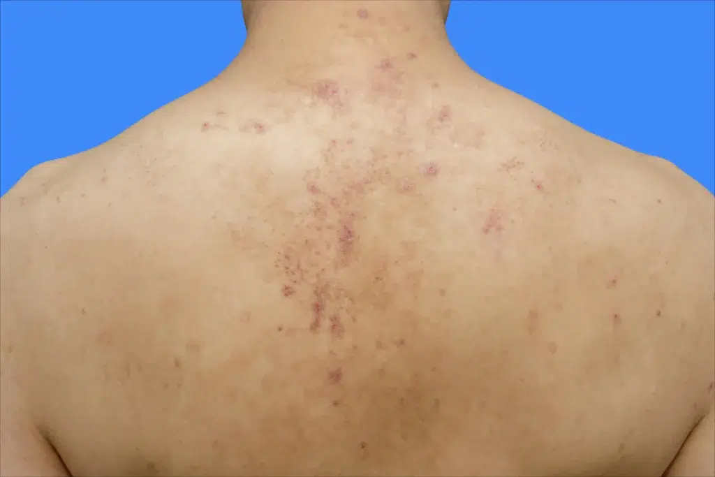 Jambes de fraise : cas de la kératose