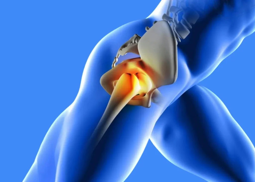 Œdème Osseux Hanche : Causes et Traitements
