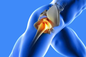 Œdème osseux de la hanche