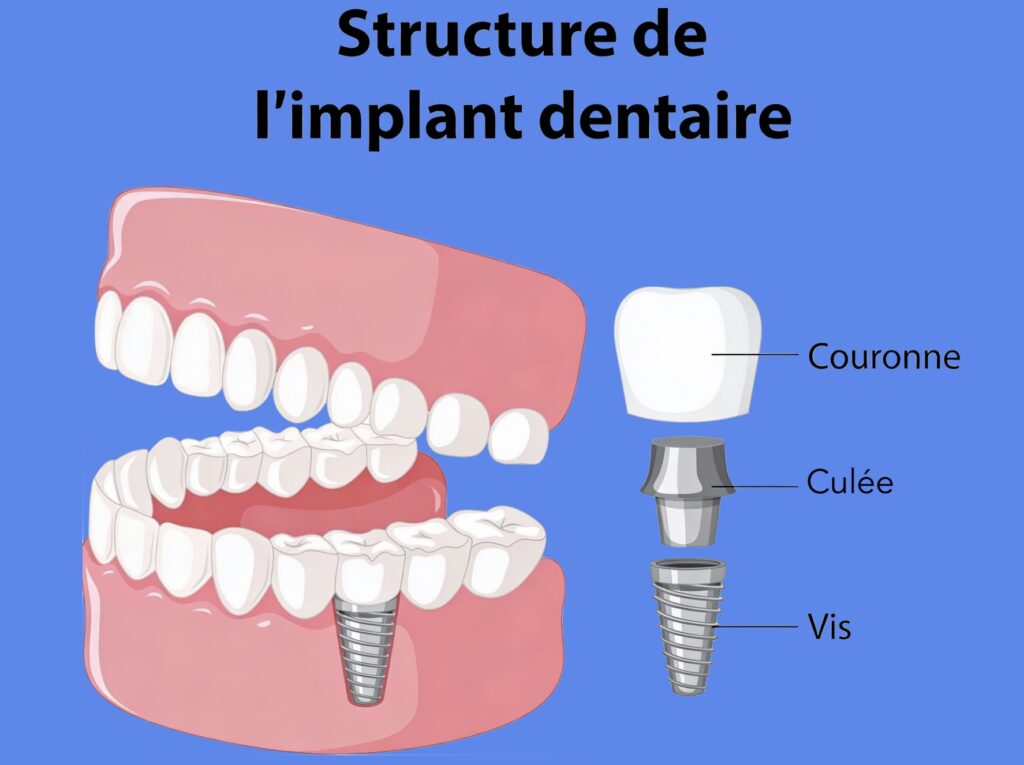structure d'un implant dentaire