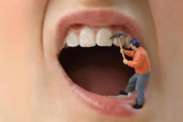 trou dans les dents : carie ?