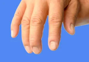 kystes mucoides doigts