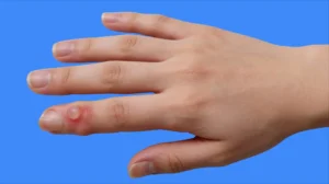 opération kyste mucoïdes doigt