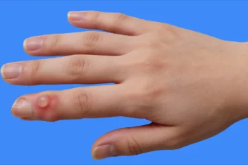 opération kyste mucoïdes doigt