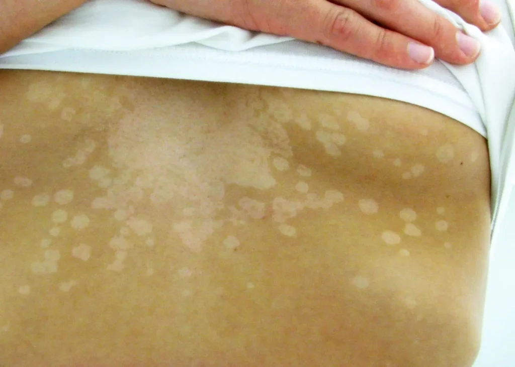 Plaque blanche - photo de pityriasis versilocor