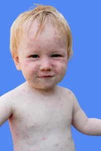 boutons de chaleur que faire