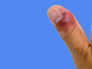 panaris quand aller aux urgences