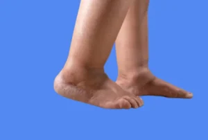 rétention d'eau jambes