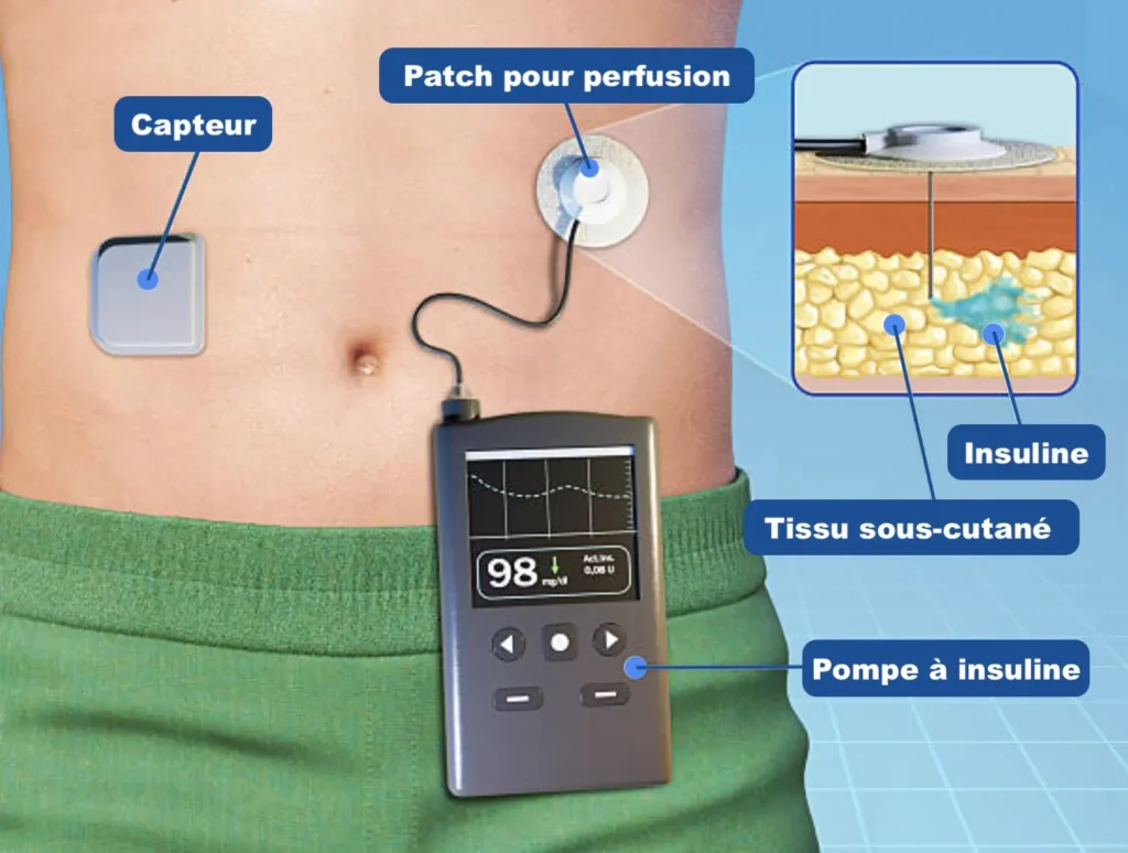 Infographie montrant la mise en place d'une pompe à insuline