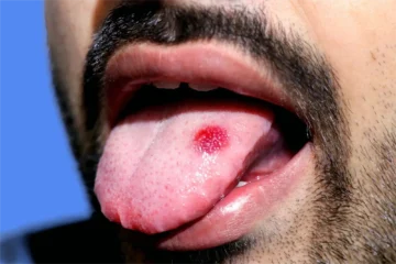 bouton langue cancer