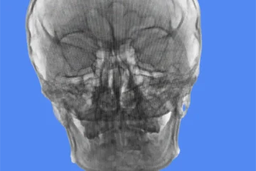 Hypertension intracrânienne idiopathique