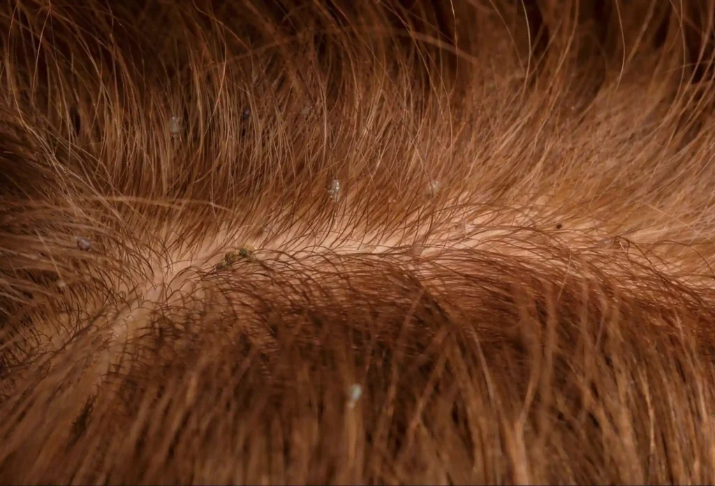 Lentes dans les cheveux : reconnaître