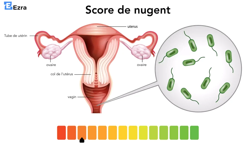 score de nugent : déséquilibre de la flore vaginale