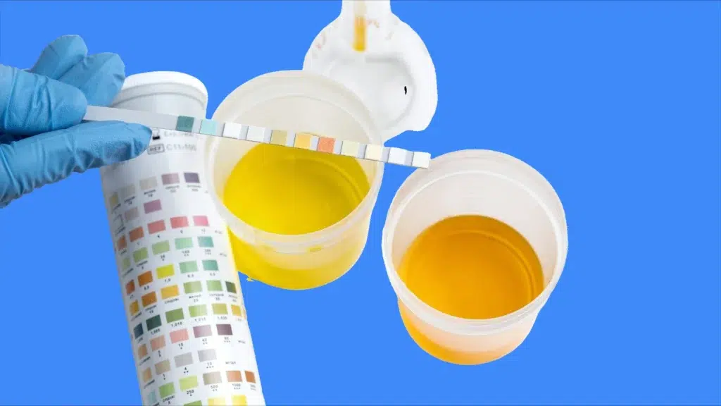 proteinurie sur echantillon : test de la bandelette